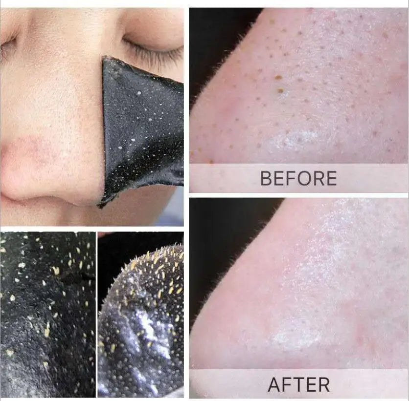 5pcs Blackhead Nasal Patch Remove Acne Suck Blackheads Deep Cleansing Shrink Pores Tear And Pull The Mask To Remove Blackheads