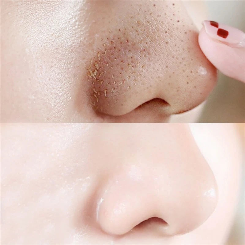 5pcs Blackhead Nasal Patch Remove Acne Suck Blackheads Deep Cleansing Shrink Pores Tear And Pull The Mask To Remove Blackheads